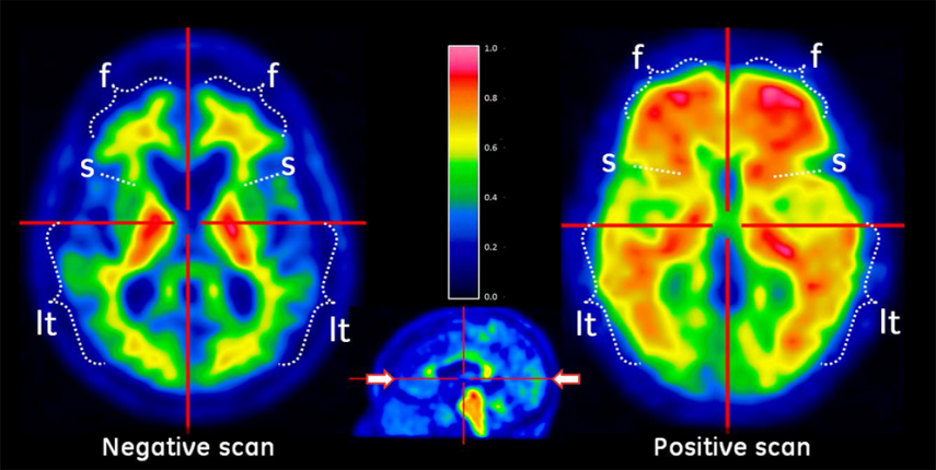 RadNet Joins UCLA-Easton Center Alzheimer’s Disease Research Study